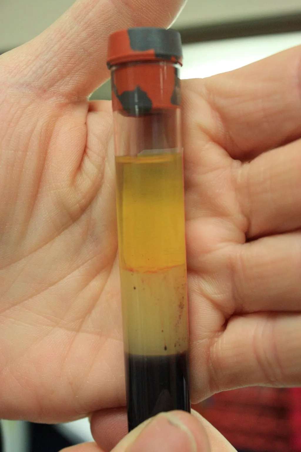 Hand holding a separated blood sample vial with serum layer above red blood cells